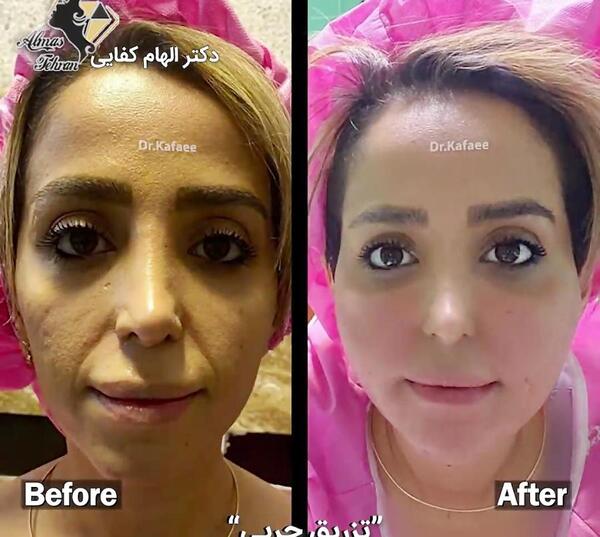 عکس قبل و بعد تزریق ژل به لب