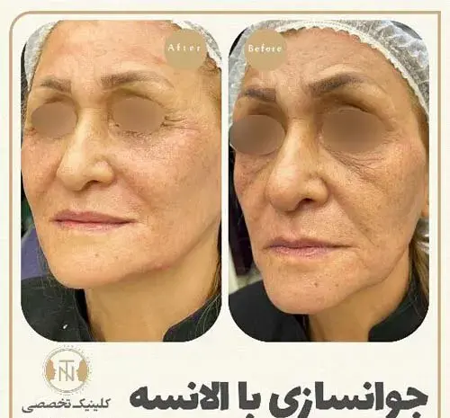 عکس قبل و بعد تزریق ژل به لب