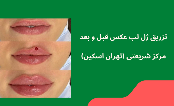 عکس قبل و بعد تزریق ژل به لب