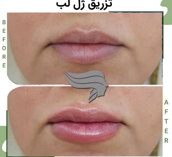 عکس قبل و بعد تزریق ژل به لب