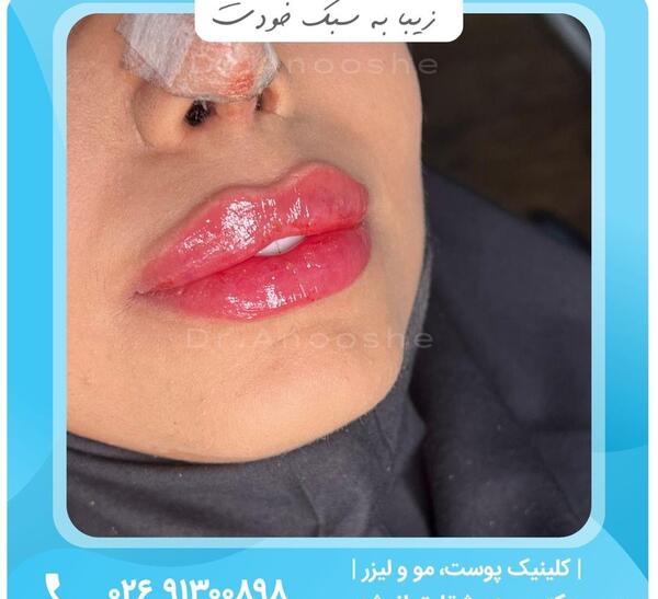 عکس قبل و بعد تزریق ژل به لب