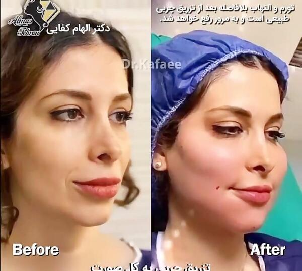 عکس قبل و بعد تزریق ژل به لب