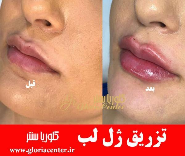 عکس قبل و بعد تزریق ژل به لب