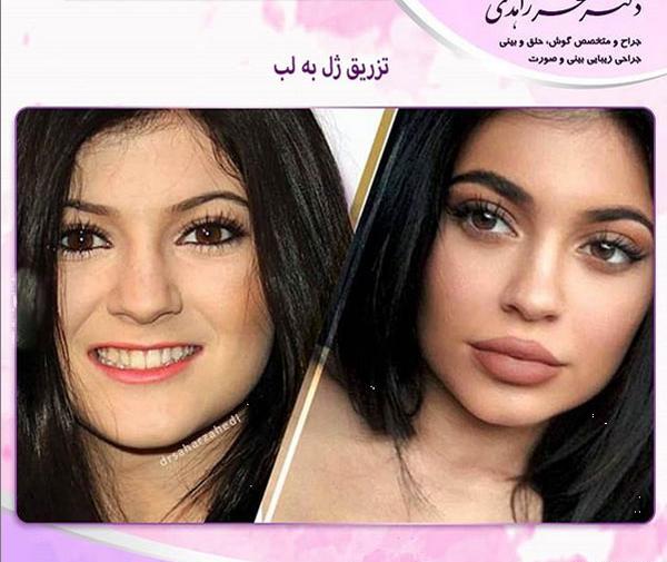 عکس قبل و بعد تزریق ژل به لب