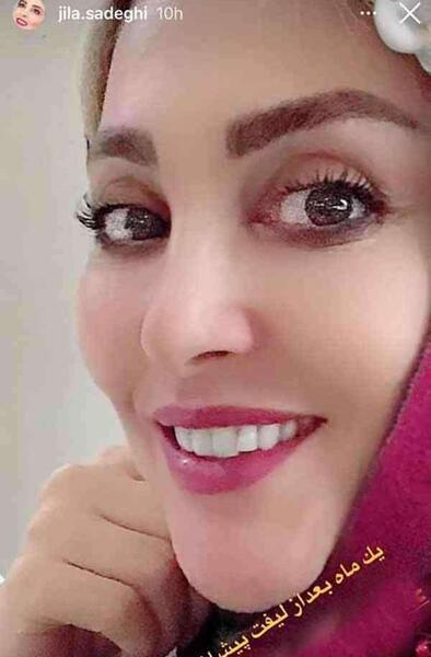 عکس قبل و بعد از عمل ژیلا صادقی