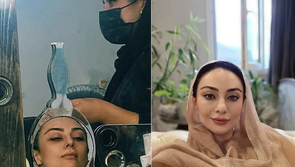 عکس یکتا ناصر قبل و بعد از عمل زیبایی