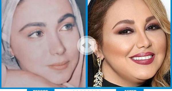 عکس قبل از عمل بینی کتایون ریاحی
