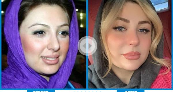 عکس قبل از عمل بینی کتایون ریاحی