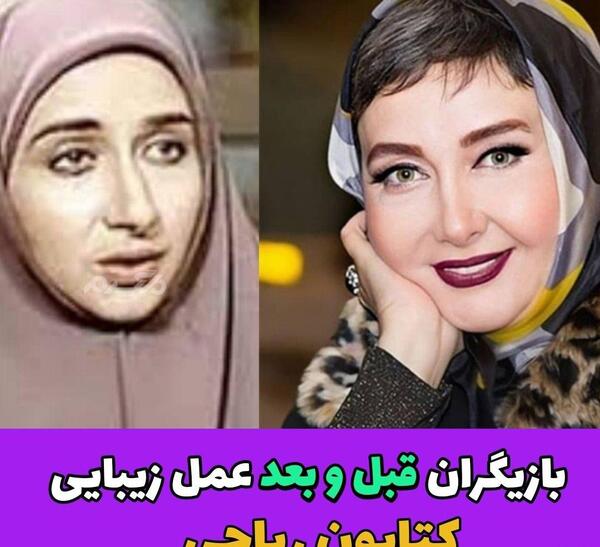 عکس قبل از عمل بینی کتایون ریاحی