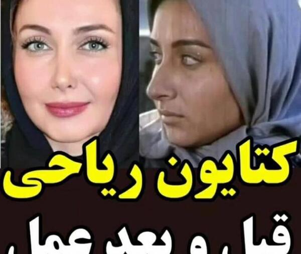 عکس کتایون ریاحی قبل از عمل دماغ