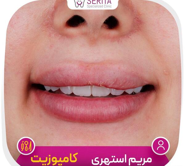 عکس کامپوزیت دندان قبل و بعد نی نی سایت