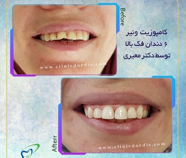 عکس قبل و بعد پولیش دندان کامپوزیت شده