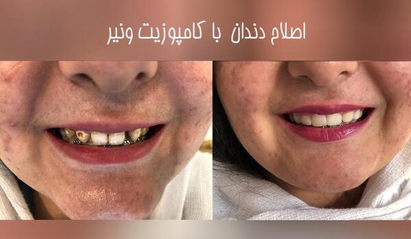 عکس قبل و بعد پولیش دندان کامپوزیت شده