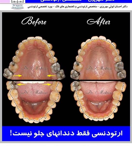 عکس دندان قبل و بعد ارتودنسی