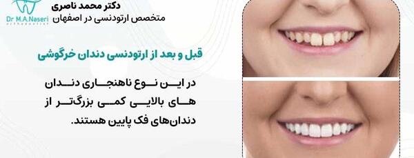 عکس دندان قبل و بعد ارتودنسی