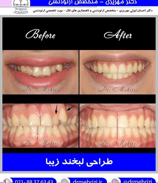 عکس دندان قبل و بعد ارتودنسی