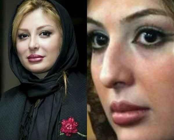 عکس قبل و بعد از عمل دماغ