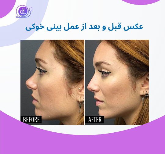 عکس قبل و بعد از عمل دماغ