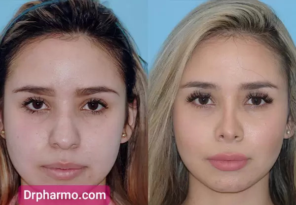 عکس قبل و بعد از عمل دماغ