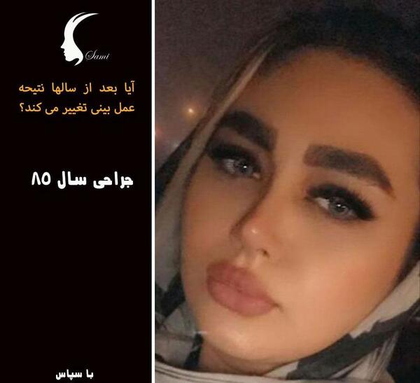 عکس قبل و بعد از عمل دماغ