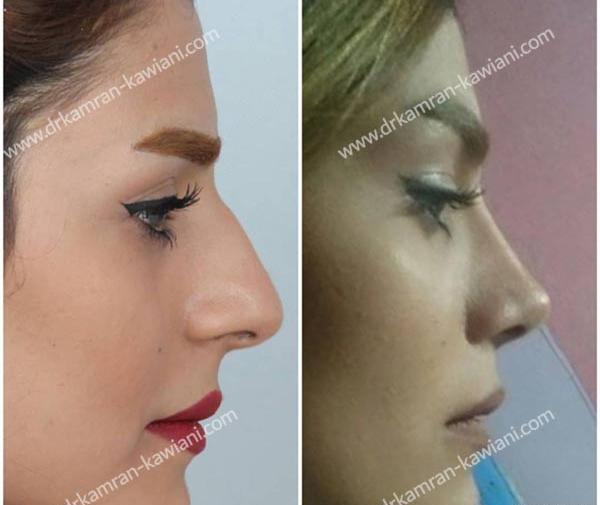 عکس قبل و بعد از عمل دماغ