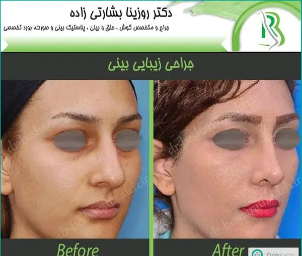 عکس قبل و بعد از عمل دماغ