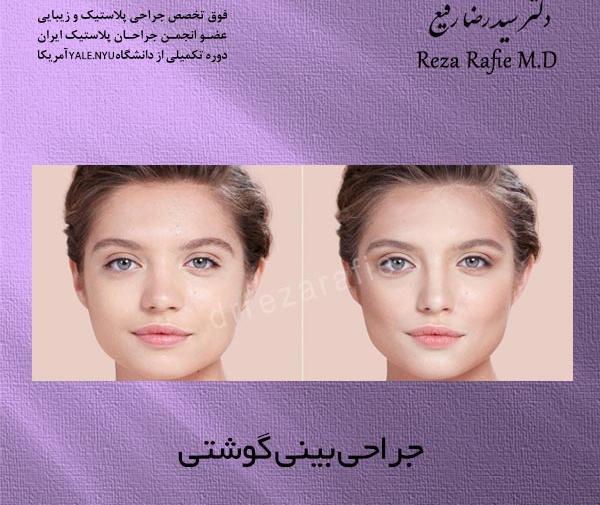 عکس قبل و بعد از عمل دماغ