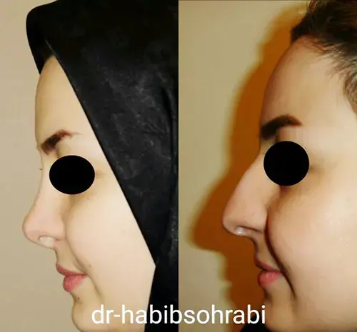 عکس قبل و بعد از عمل دماغ