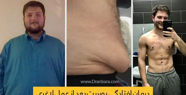 عکس قبل و بعد چاقی بدن