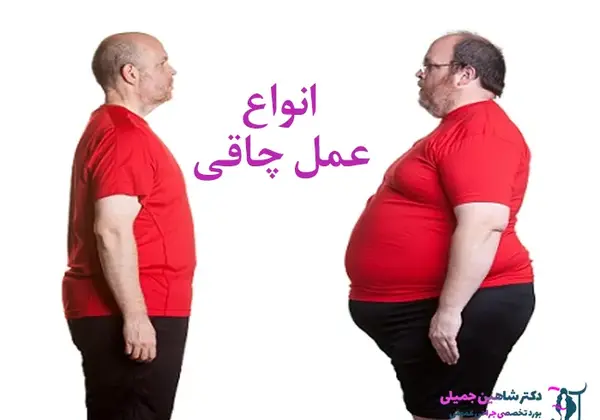 عکس قبل و بعد چاقی بدن