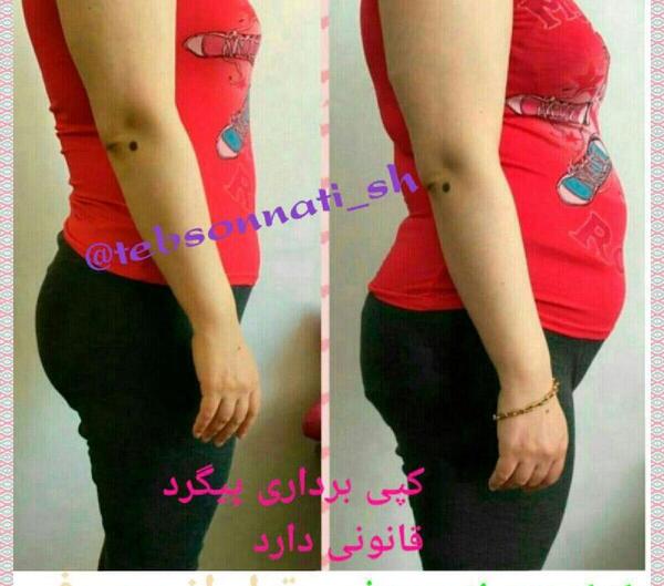 عکس قبل و بعد چاقی بدن