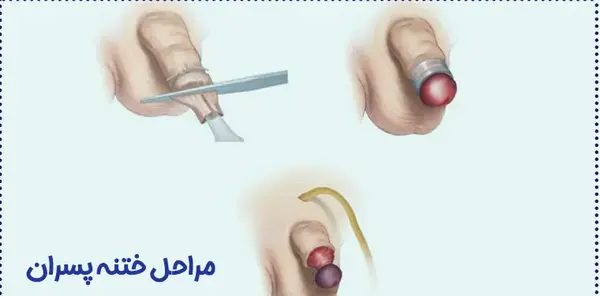 عکس قبل ختنه پسر
