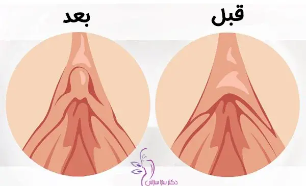 عکس قبل از ختنه