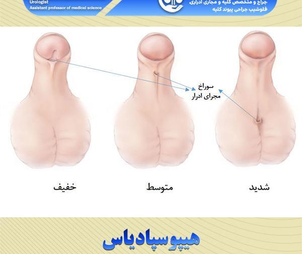 عکس قبل از ختنه