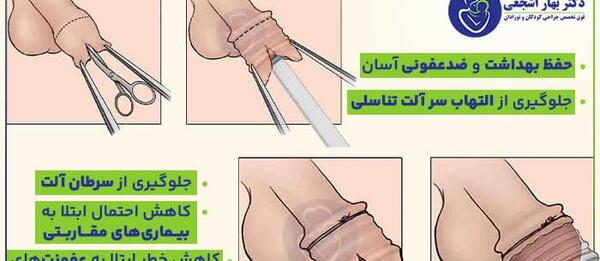 عکس قبل و بعد ختنه نوزاد