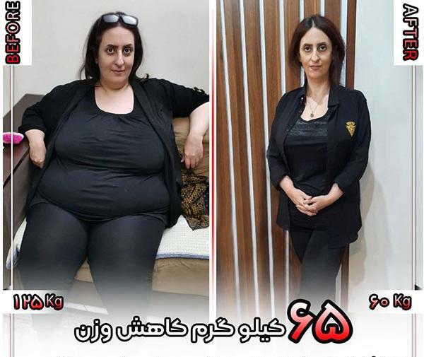 عکس قبل و بعد از چاقی