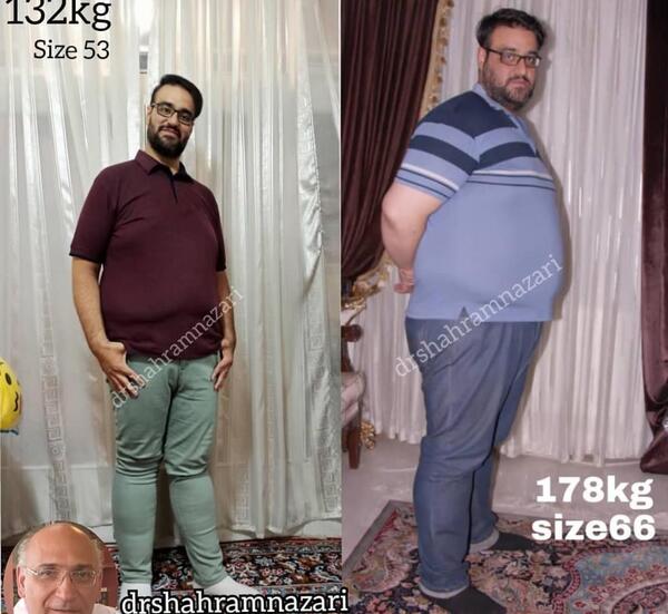 عکس قبل و بعد از چاقی