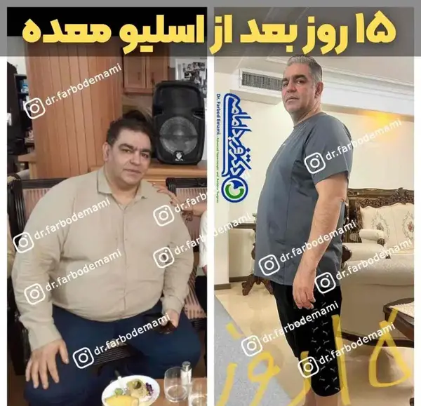 عکس قبل و بعد از چاقی