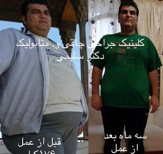 عکس قبل و بعد از چاقی