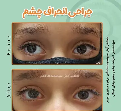 عکس انحراف چشم قبل و بعد از عمل