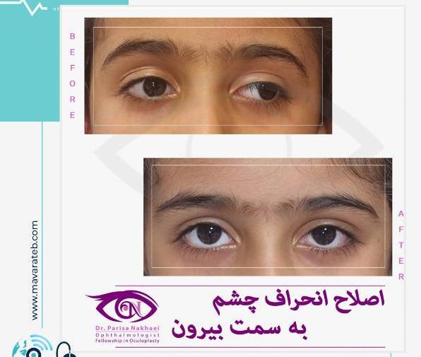 عکس انحراف چشم قبل و بعد از عمل