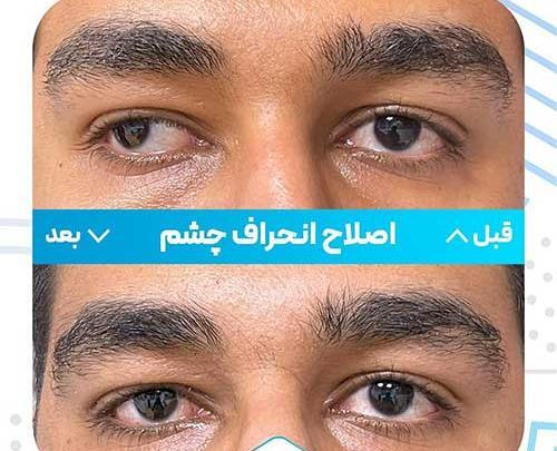 عکس انحراف چشم قبل و بعد از عمل