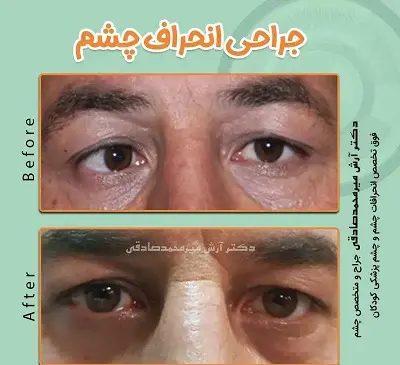 عکس انحراف چشم قبل و بعد از عمل