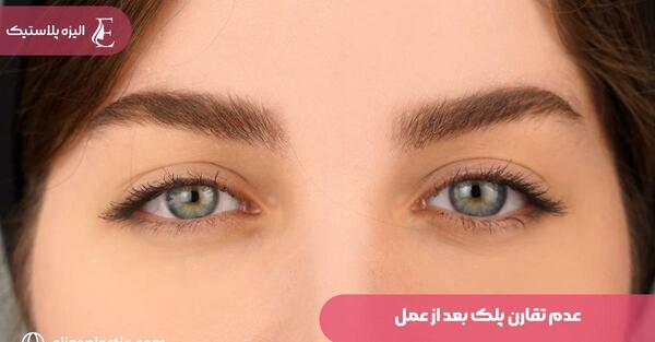 عکس انحراف چشم قبل و بعد از عمل