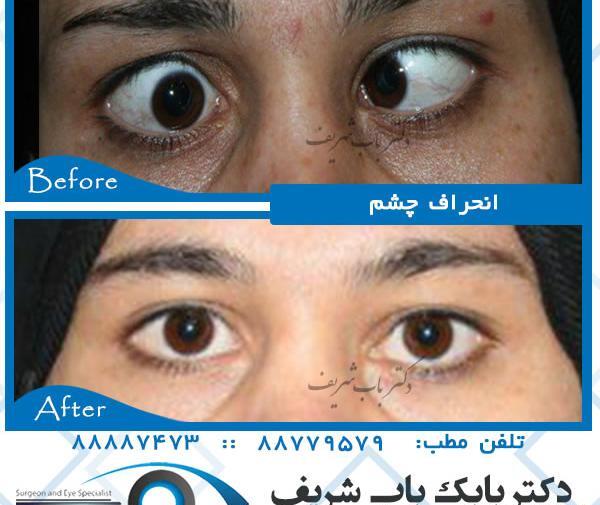 عکس انحراف چشم قبل و بعد از عمل