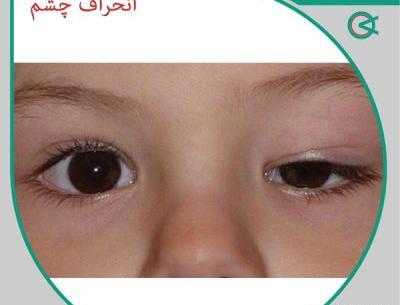 عکس انحراف چشم قبل و بعد از عمل