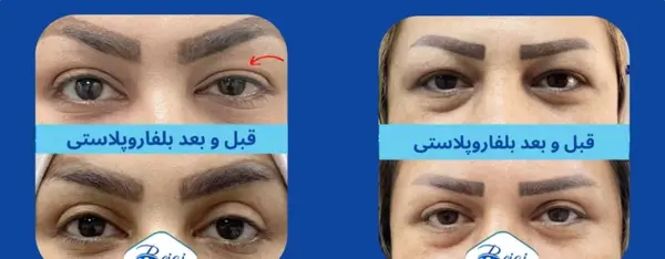 عکس قبل و بعد چهره