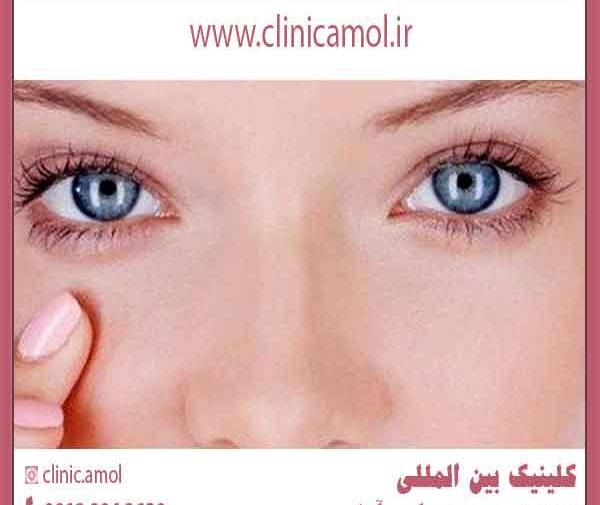 عکس قبل از عمل چشم