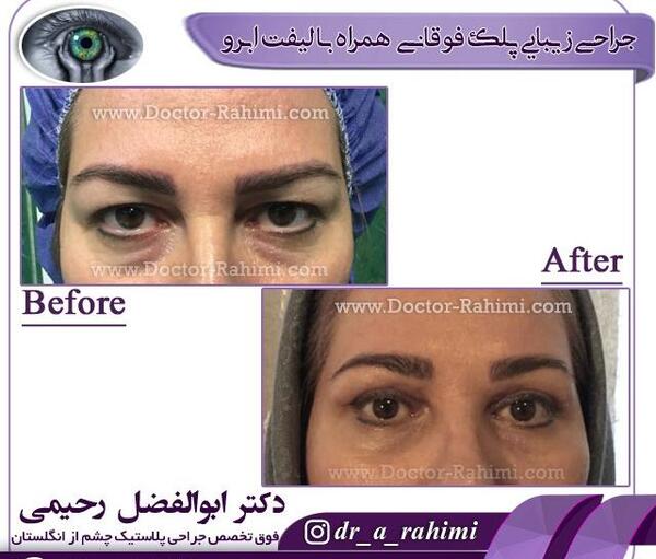 عکس قبل از عمل چشم