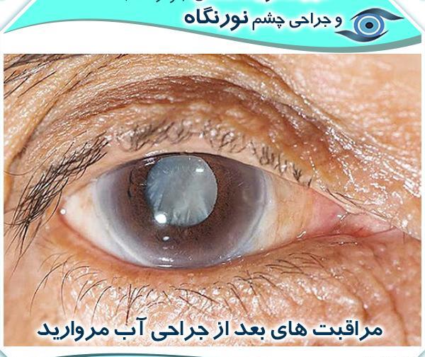 عکس قبل از عمل چشم